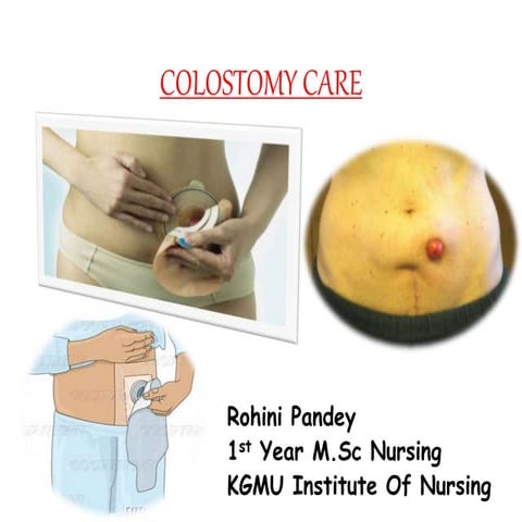 Colostomy care