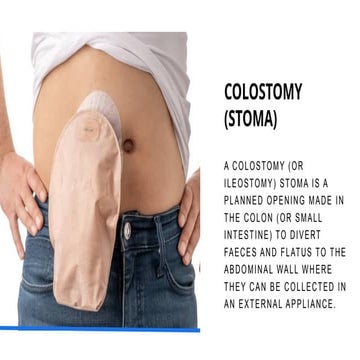 MBBS SURGERY TOPIC - COLOSTOMY (STOMA).pptx