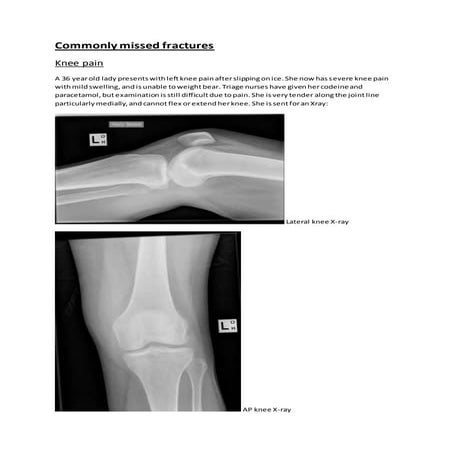 Commonly missed Fractures