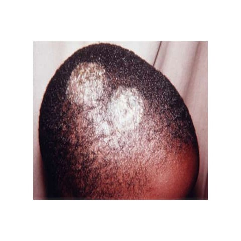 Common Rashes Not To Miss