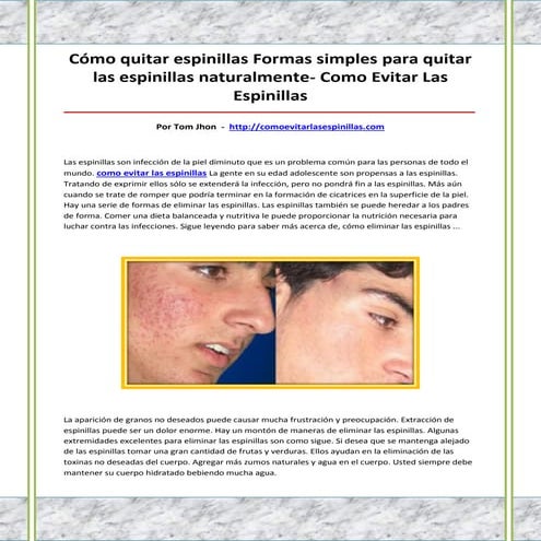 Como evitar las espinillas