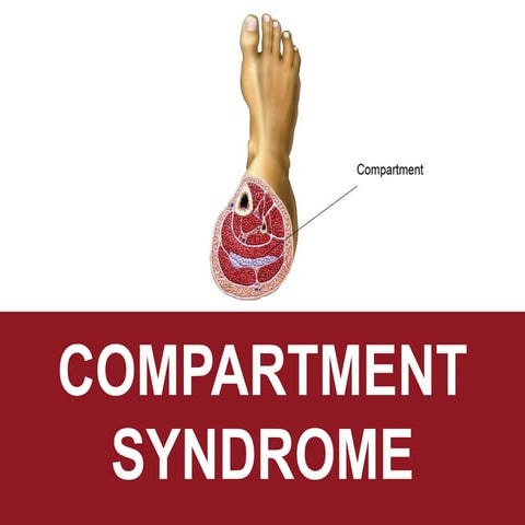 Compartment syndrome