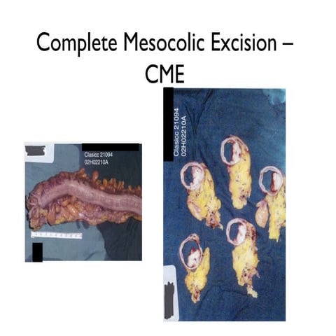 Complete mesocolic excision