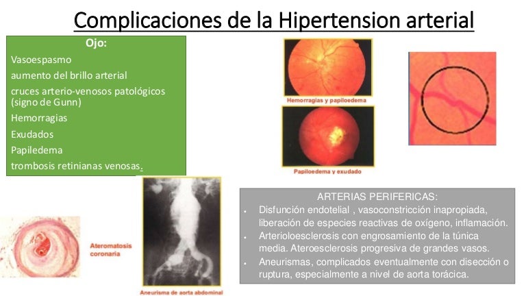 Hipertensión en madre trabajadora Hipertensión en madre trabajadora