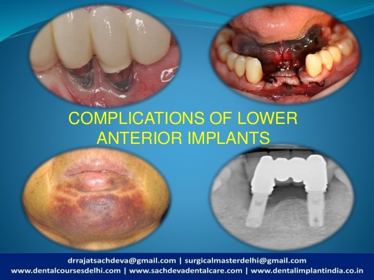 Complications of lower anterior implants Complications of Dental Imp…