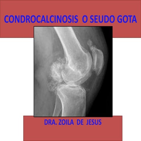 Condrocalcinosis | PPTX