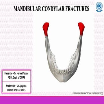Condyle Fractures.pptx
