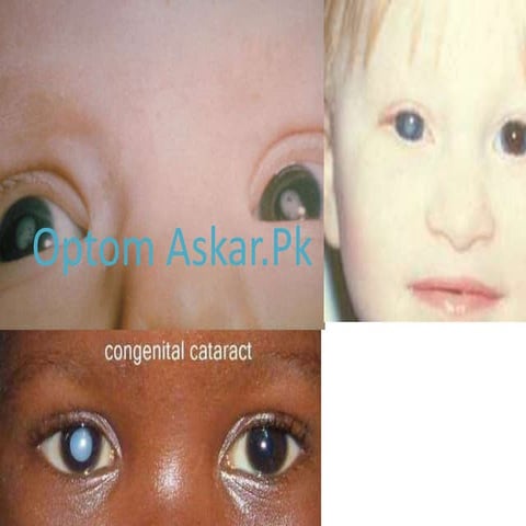 Congenital cataract