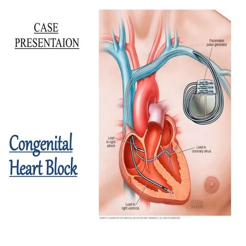 Congenital heart block