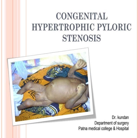 Congenital hypertrophic pyloric stenosis
