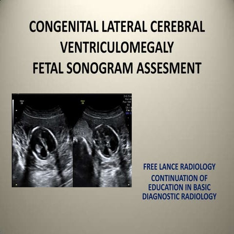 Congenital lateral ventriculomegaly.