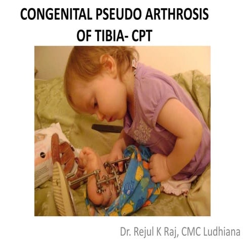 Congenital pseudo arthrosis of tibia