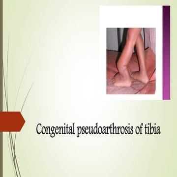 Congenital pseudoarthrosis of tibia