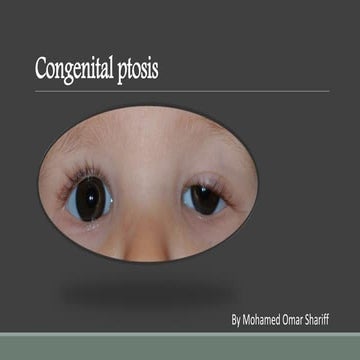 Congenital ptosis