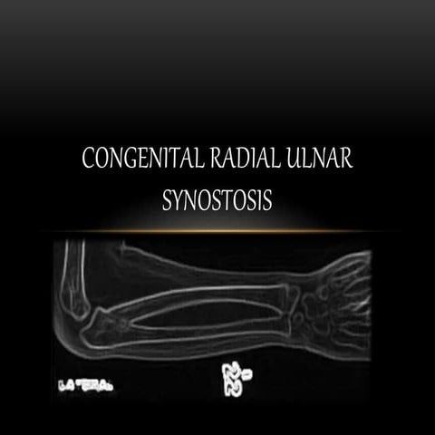 Congenital Radial Ulnar Synostosis.pptx