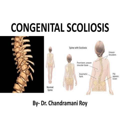 congenital-scoliosis-ppt