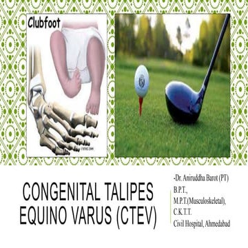 Congenital talipes equino varus (CTEV) | PPTX