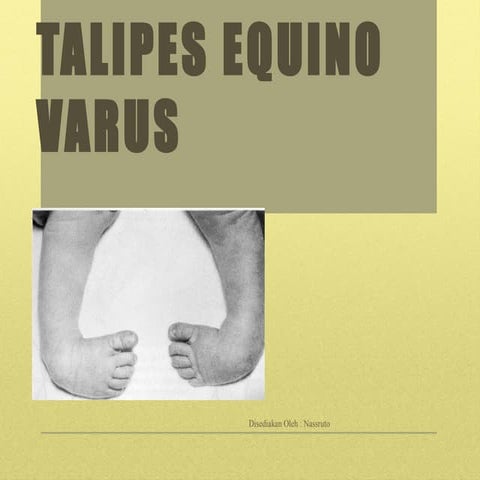 CONGENITAL TALIPES EQUINO VARUS & SPINA BIFIDA