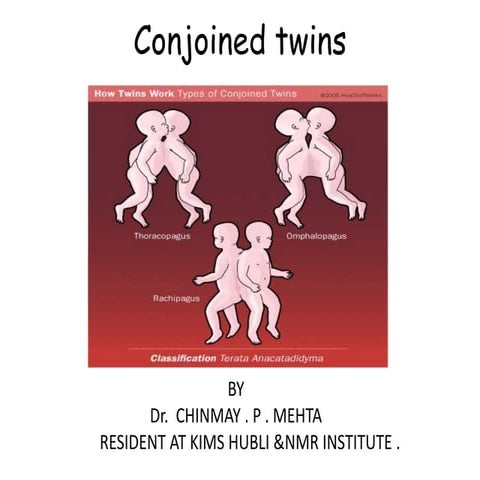 Conjoined twins