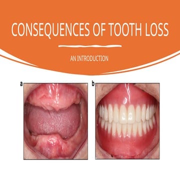 complete dentures(sequel of tooth loss).pptx