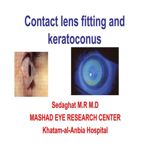 contact lenses fitting for KCN