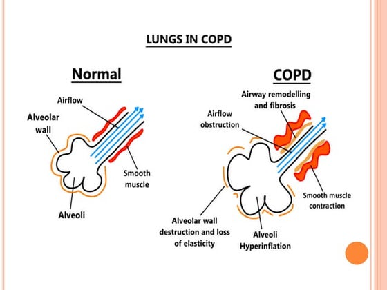 Pathophysiology of copd | PPT