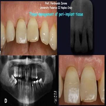 Tissue Management of Peri-implant Tissue | PDF