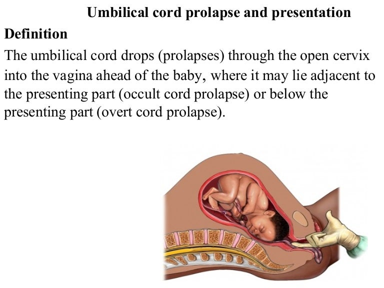 meaning of cord presentation