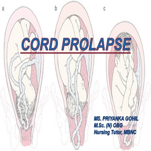 Cord prolapse