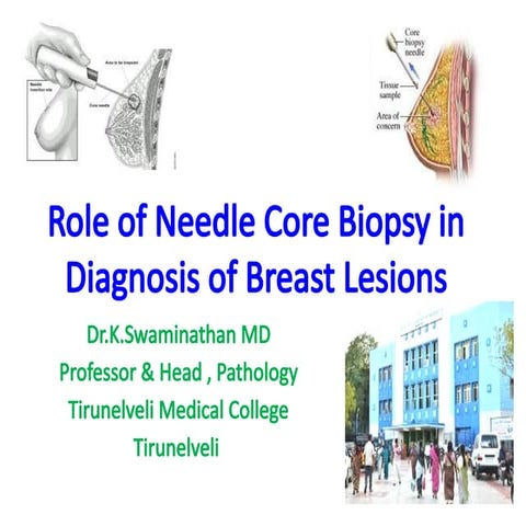 Core Needle Biopsy in Breast Lesion.pptx