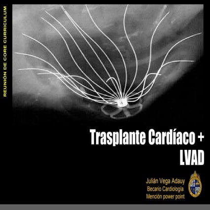 Trasplante Cardiaco & Asistencia Ventricular, Heart Transplant