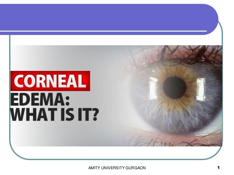 Corneal edema