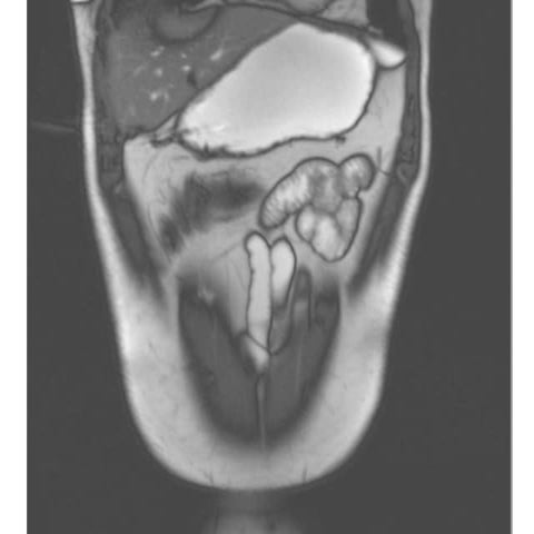 Colo-colic intussusception | PPT