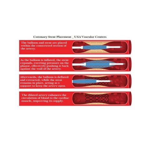 What is an Angioplasty Procedure | USA Vascular Centers | PDF
