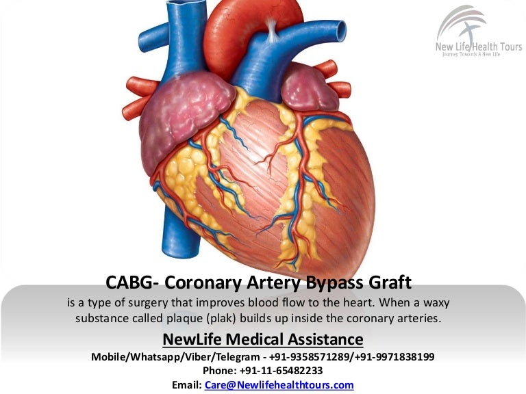 Coronary Artery Bypass Graft(CABG), Open Heart Surgery in
