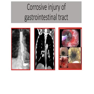 Corrosive injury review article and management.pptx