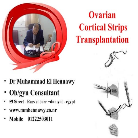 Cortical ovarian strips transplant