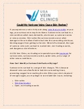 How to remove varicose and spider veins | PPTX | Blood Disorders ...