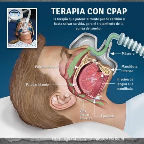 Cpap uso y causas