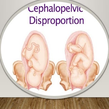 Cephalopelvic disproportion | PPTX