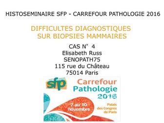 CANCER MAMMAIRE : CARCINOME PAPILLAIRE INFILTRANT