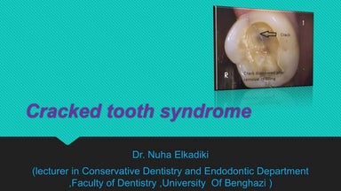 Cracked tooth syndrom