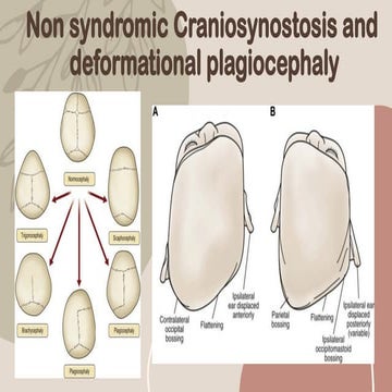 non syndromic craniosynostosis and deformational plagicephaly.pptx