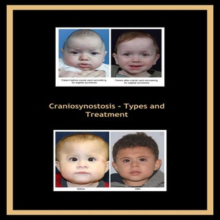 Craniosynostosis types-and-treatment