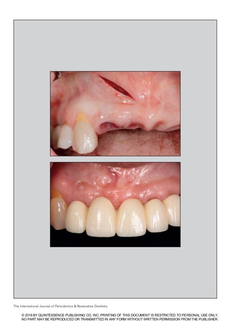 Creating papilla implant (dentalxp) by Stuart