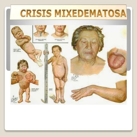 crisis-mixedematosa-pptx