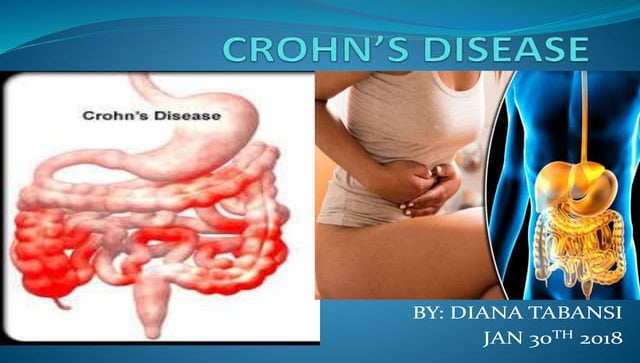 ulcerative-colitis-seminar-topic-ppt-002