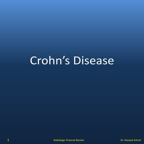 Crohns disease