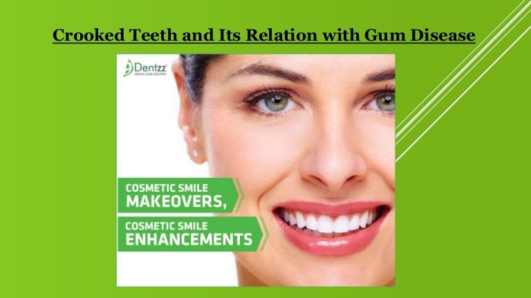 Crooked teeth and its relation with gum disease