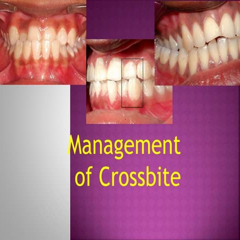 Cross bite and it's management venkat